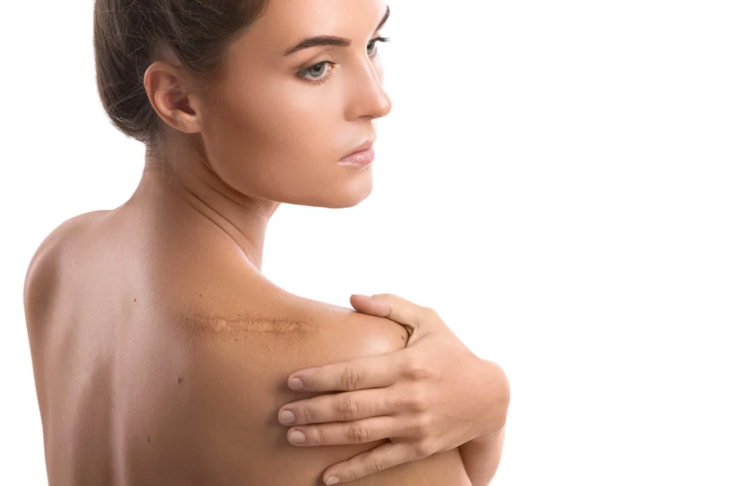 Scar on girl's back | ANEU Medical Spa in Madison WI