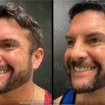 Before and after photo | wrinkle removal | ANEU Medical Spa | McFarland | Madison, FL
