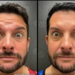 Before and after photo | forehead wrinkles treatment | ANEU Medical Spa | McFarland | Madison, FL