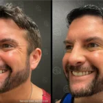 Before and after photo | Facial wrinkles | ANEU Medical Spa | McFarland | Madison, FL