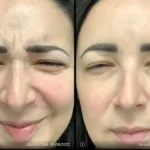 Before and after photo | Neuromodulators injections | ANEU Medical Spa | McFarland | Madison, FL