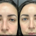 Before and after photo | prp undereye | ANEU Medical Spa | McFarland | Madison, FL