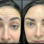 Before and after photo | wrinkles treatment on forehead | ANEU Medical Spa | McFarland | Madison, FL