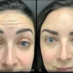 Before and after photo | filler treatment | ANEU Medical Spa | McFarland | Madison, FL