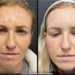 Before and after photo | sculptra | ANEU Medical Spa | McFarland | Madison, FL