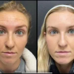 Before and after photo | lines reduction from forehead | ANEU Medical Spa | McFarland | Madison, FL