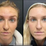 Before and after photo | fine lines reduction | ANEU Medical Spa | McFarland | Madison, FL