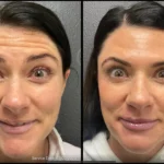 Before and after photo | wrinkle therapy | ANEU Medical Spa | McFarland | Madison, FL