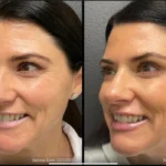 Before and after photo | fine lines reduction from face | ANEU Medical Spa | McFarland | Madison, FL