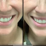Before and after photo | teeth | ANEU Medical Spa | McFarland | Madison, FL