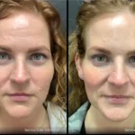 Before and after photo | fine lines treatment on forehead | ANEU Medical Spa | McFarland | Madison, FL
