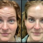 Before and after photo | deep wrinkles treatment on forehead | ANEU Medical Spa | McFarland | Madison, FL