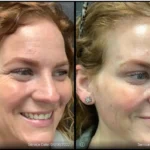 Before and after photo | botox for wrinkles | ANEU Medical Spa | McFarland | Madison, FL