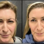 Before and after photo | fine lines under eyes | ANEU Medical Spa | McFarland | Madison, FL