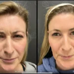 Before and after photo | wrinkles treatment for face | ANEU Medical Spa | McFarland | Madison, FL
