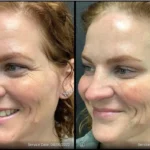 Before and after photo | facial wrinkles treatment | ANEU Medical Spa | McFarland | Madison, FL