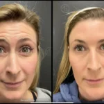 Before and after photo | wrinkle on forehead | ANEU Medical Spa | McFarland | Madison, FL