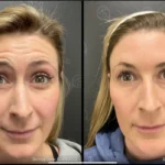 Before and after photo | wrinkles removal from forehead | ANEU Medical Spa | McFarland | Madison, FL