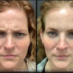 Before and after photo | wrinkles treatment on forehead | ANEU Medical Spa | McFarland | Madison, FL