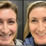 Before and after photo | Neuromodulators for wrinkles | ANEU Medical Spa | McFarland | Madison, FL