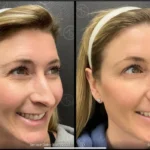 Before and after photo | wrinkles removal from face | ANEU Medical Spa | McFarland | Madison, FL