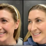 Before and after photo | wrinkles reduction around eyes | ANEU Medical Spa | McFarland | Madison, FL