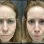 Before and after photo | frown lines on forehead | ANEU Medical Spa | McFarland | Madison, FL