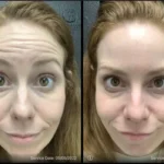 Before and after photo | wrinkles removal treatment | ANEU Medical Spa | McFarland | Madison, FL