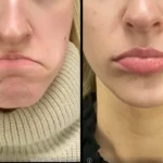 Before and after photo | glossy lips | ANEU Medical Spa | McFarland | Madison, FL