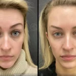 Before and after photo | lines on forehead | ANEU Medical Spa | McFarland | Madison, FL