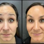 Before and after photo | forehead wrinkles reduce | ANEU Medical Spa | McFarland | Madison, FL