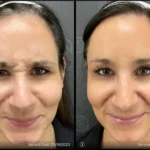 Before and after photo | facial lines treatment | ANEU Medical Spa | McFarland | Madison, FL
