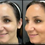 Before and after photo | facial fine lines treatment | ANEU Medical Spa | McFarland | Madison, FL