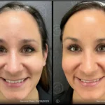 Before and after photo | smooth skin | ANEU Medical Spa | McFarland | Madison, FL