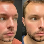 Before and after photo | Facial redness reduction | ANEU Medical Spa | McFarland | Madison, FL