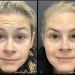 Before and after photo | wrinkles treatment on forehead | ANEU Medical Spa | McFarland | Madison, FL