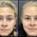 Before and after | forehead lines on face | ANEU Medical Spa | McFarland | Madison, FL