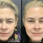 Before and after | wrinkle removal service | ANEU Medical Spa | McFarland | Madison, FL