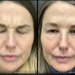 Before and after | sagging eyelid | ANEU Medical Spa | McFarland | Madison, FL