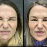 Before and after | fine lines and wrinkles | ANEU Medical Spa | McFarland | Madison, FL