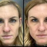 Before and after | wrinkles removal from face | ANEU Medical Spa | McFarland | Madison, FL