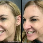 Before and after | Facial rejuvenation | ANEU Medical Spa | McFarland | Madison, FL