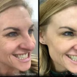 Before and after | Halo | ANEU Medical Spa | McFarland | Madison, FL