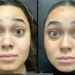 Before and after | forehead fine lines | ANEU Medical Spa | McFarland | Madison, FL