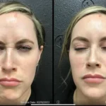 Before and after | frown wrinkles | ANEU Medical Spa | McFarland | Madison, FL