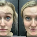 Before and after | forehead wrinkles treatment | ANEU Medical Spa | McFarland | Madison, FL