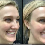 Before and after | wrinkles reduction | ANEU Medical Spa | McFarland | Madison, FL
