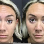 Before and after | forehead lines | ANEU Medical Spa | McFarland | Madison, FL