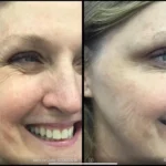 Before and after | facial wrinkles | ANEU Medical Spa | McFarland | Madison, FL