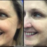 Before and after | wrinkles | ANEU Medical Spa | McFarland | Madison, FL